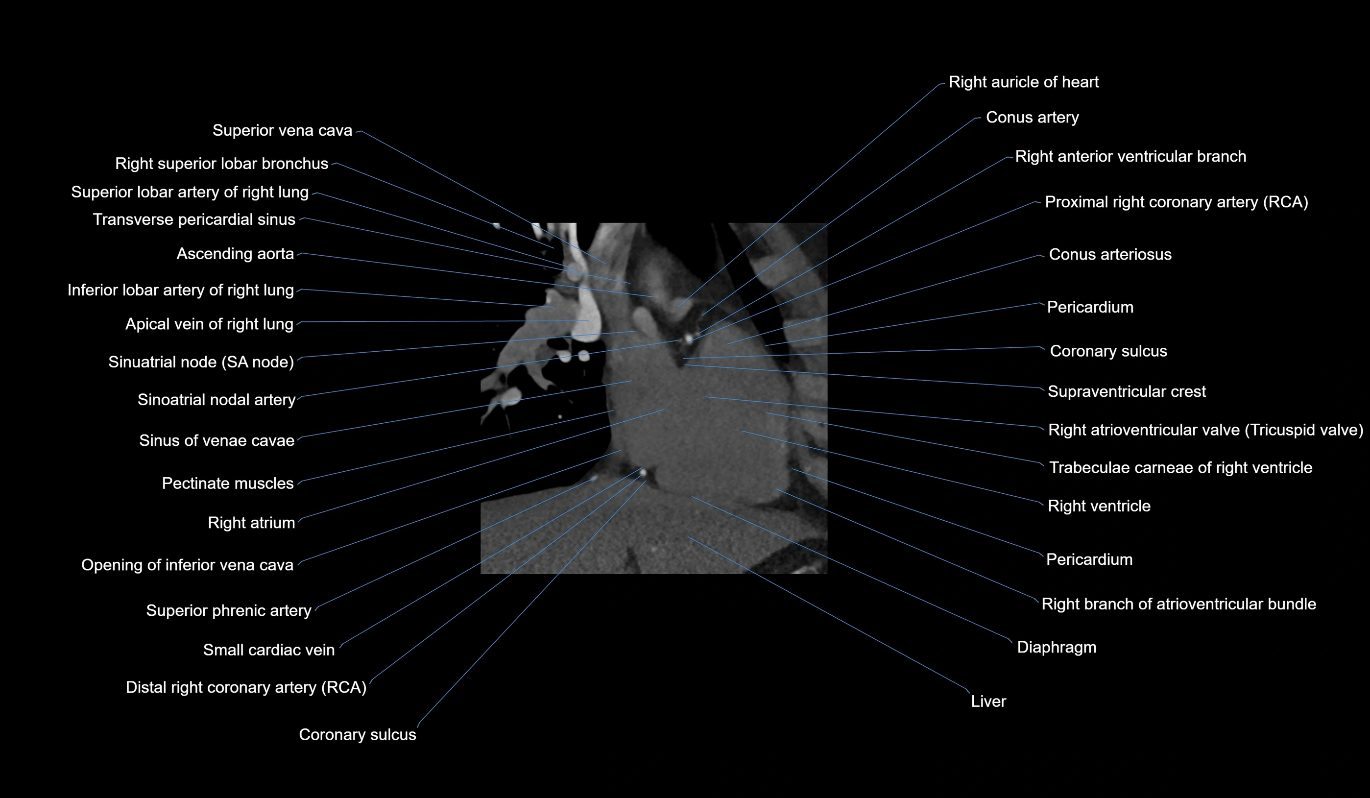 CT heart (coronary angiogram) 2 chamber view cross sectional anatomy labelled radiology image-00031.webp